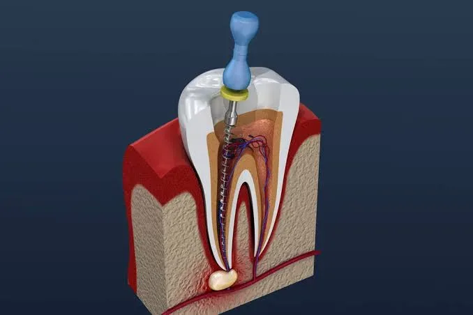 Endodonti (Kanal Tedavisi): Nedir ve Nasıl Uygulanır?
