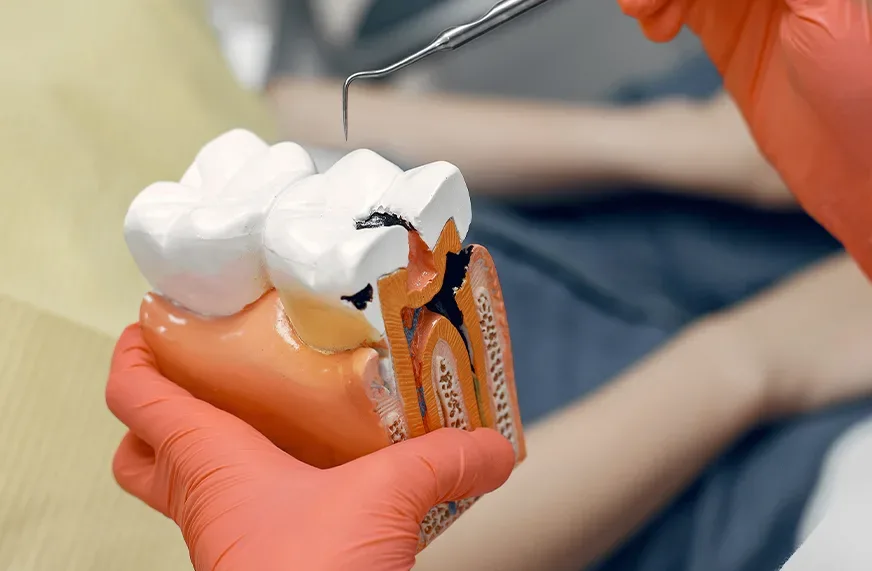 Bursa Kanal Tedavisi: Endodonti Süreçleri ve Bilinmesi Gerekenler